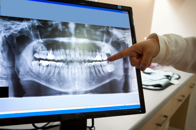 fogászati panoráma röntgen